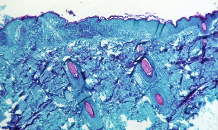 Estudo revisado por pares descobre Monkeypox principalmente transmitido sexualmente por homens
