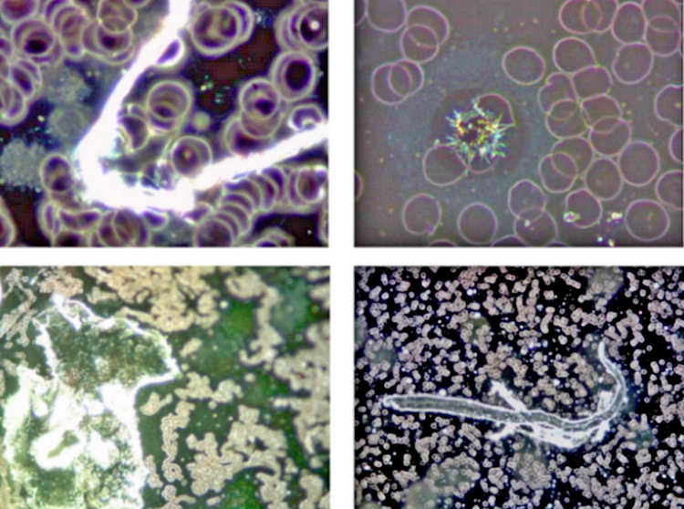 Unusual Toxic Components Found in COVID Vaccines, ‘Without Exception’: German Scientists