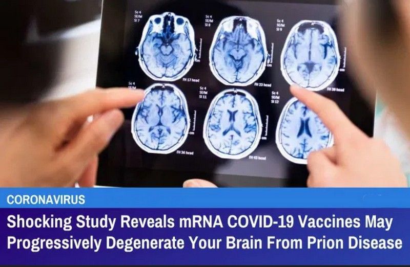 Researchers Suspect New Variants of Rapidly-Progressing Brain Degenerating Diseases from COVID-19 Vax